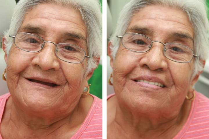 Una paciente antes y después de su prótesis